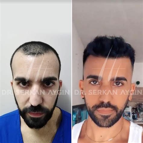 Dr. Serkan Aygin Hair Transplant Clinic Reviews .